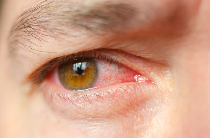 5 Basic Eye Infections